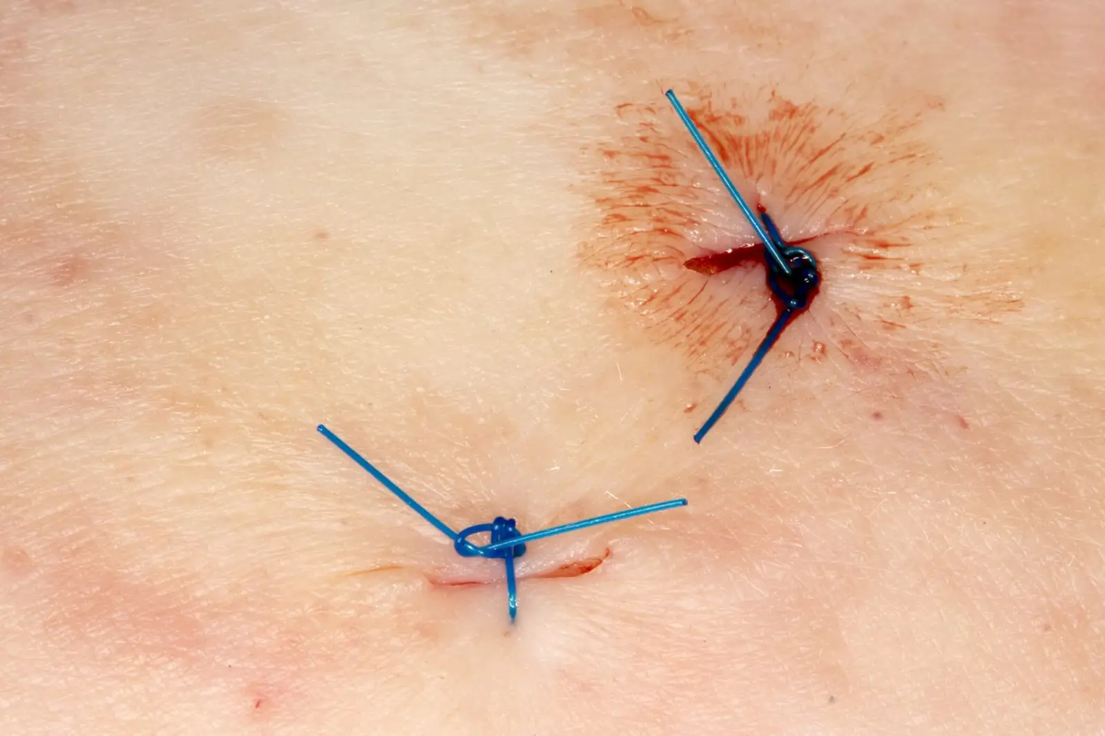 بیوپسی بافت