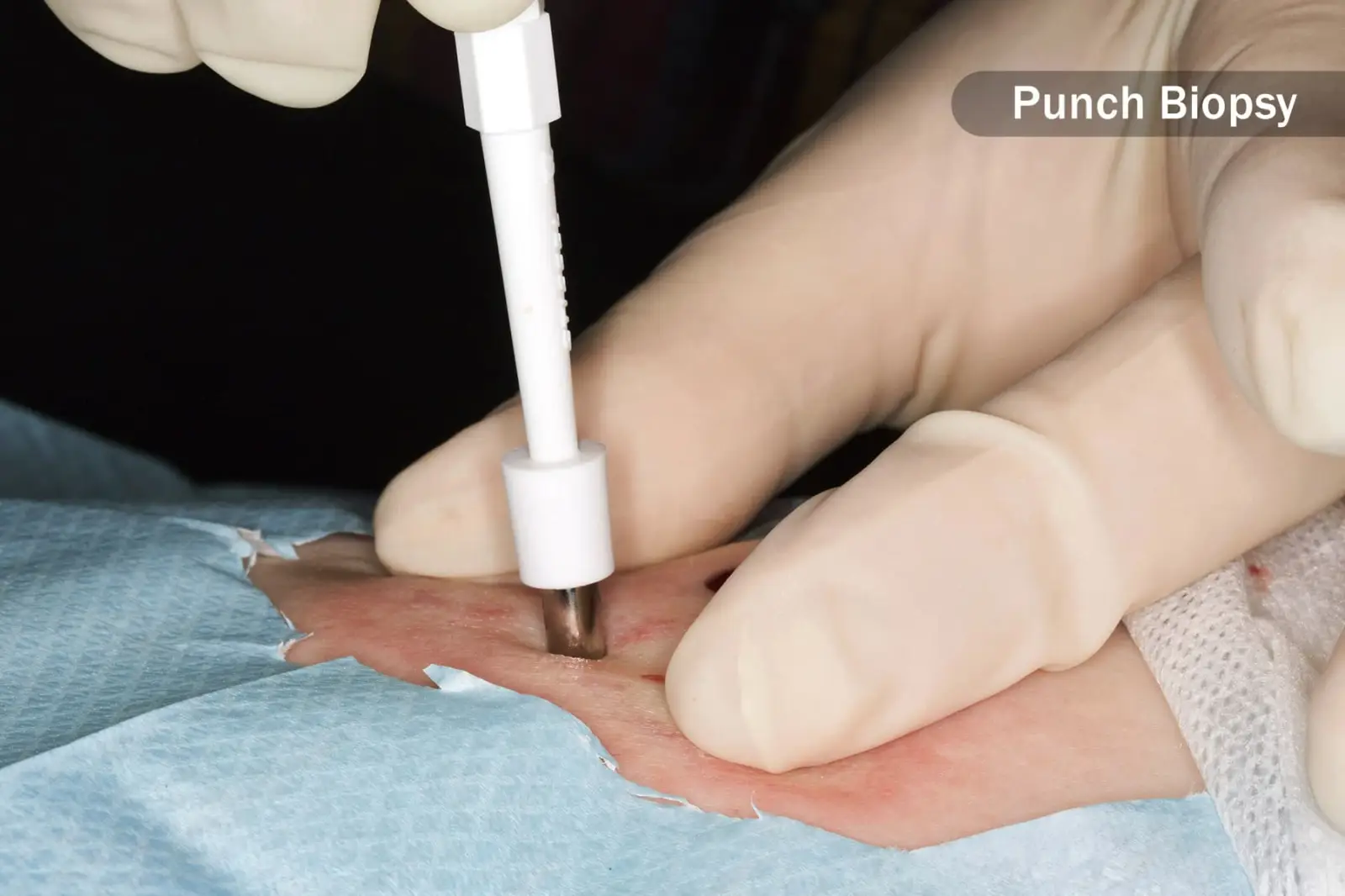 بیوپسی بافت